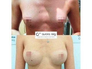 Aumento de pecho - Aurora Reig