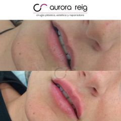 Aumento de labios - Aurora Reig