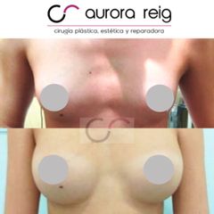 Aumento de pecho - Aurora Reig