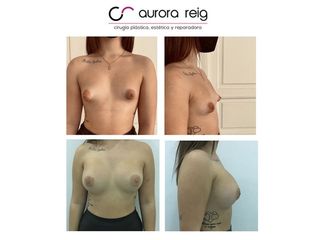 Aumento de pecho - Aurora Reig