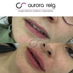 Aumento de labios - Aurora Reig
