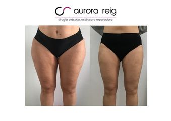Liposucción - Aurora Reig