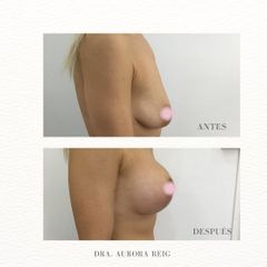 Aumento de pecho - Aurora Reig