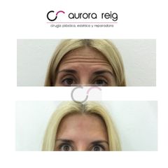 Rellenos faciales - Aurora Reig