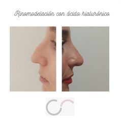 Rinomodelación - Aurora Reig