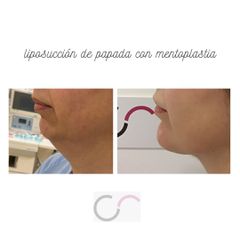 Liposucción de papada - Aurora Reig