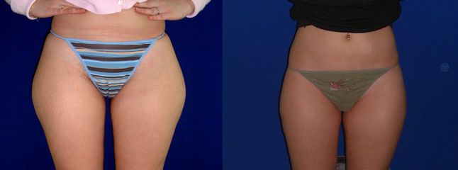 Liposucción - Dr. Josep Márquez