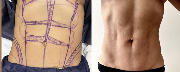 Abdominoplastia - Dr. Josep Márquez