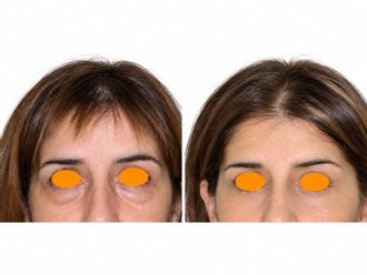 Eliminación ojeras antes y después - 881236