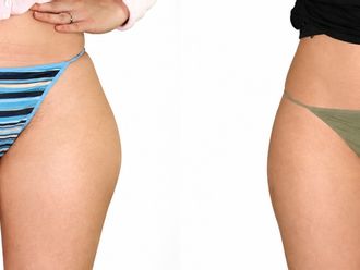 Liposucción antes y después - 881237