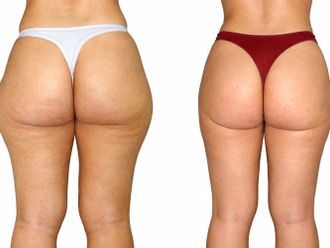 Liposucción antes y después - 881238