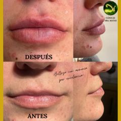 Aumento labios - Clínicas Dra. Matas