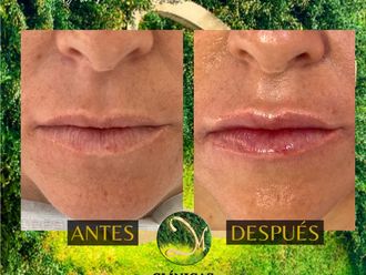 Aumento labios antes y después - 870088