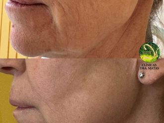 Rejuvenecimiento facial antes y después - 871785