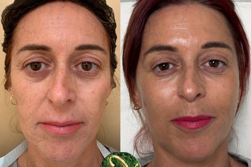 Rellenos faciales antes y después - 872172