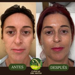 Armonización Facial - Clínicas Dra. Matas