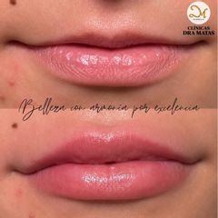 Clínicas Dra. Matas - SIMETRIA LABIAL