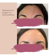 Antes y después Arrugas frontales-Tratamiento Bótox