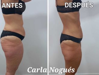 Presoterapia antes y después - 841999