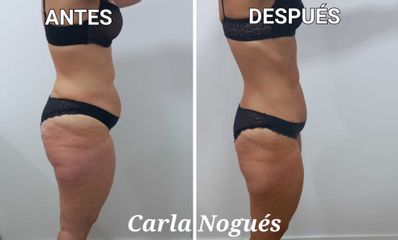 Presoterapia - Carla Nogués