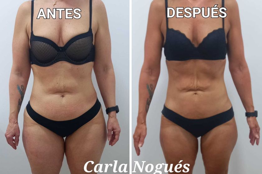 Cavitación antes y después - 842000