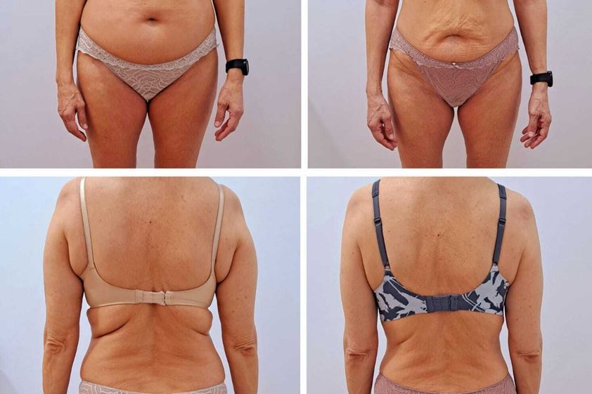 Presoterapia antes y después - 842002