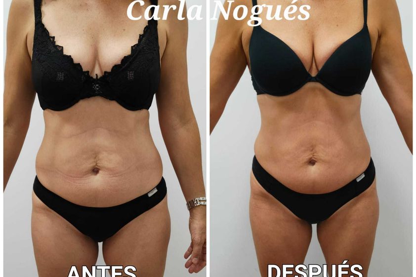 Cavitación antes y después - 842003