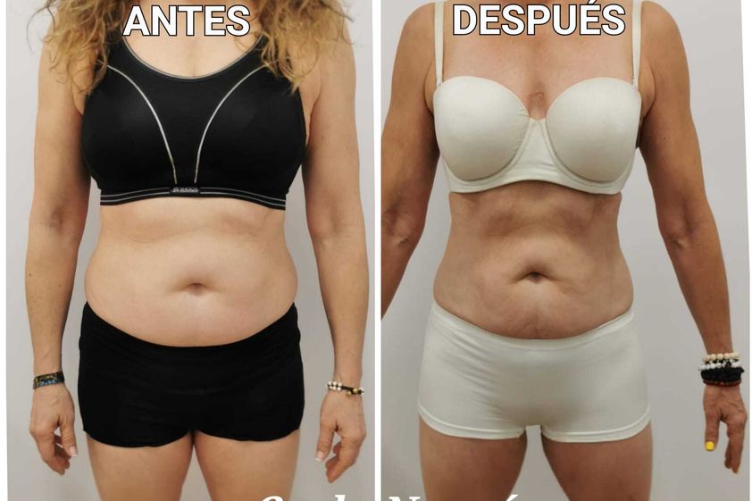 Presoterapia antes y después - 842004