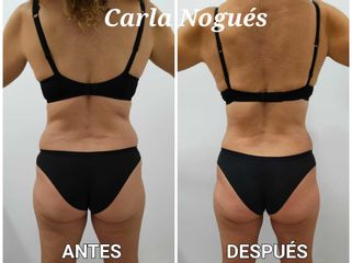 Lipoláser - Carla Nogués