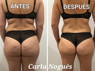 Presoterapia antes y después - 842009