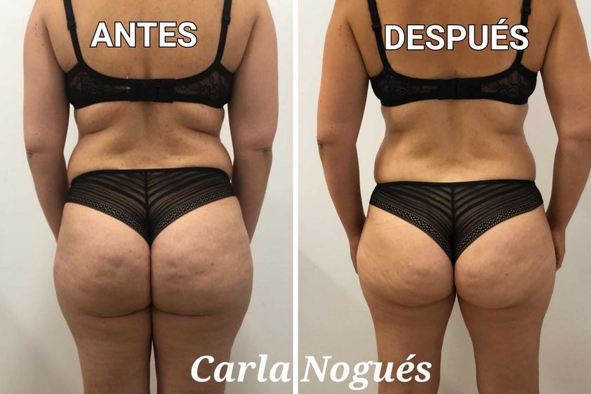 Presoterapia antes y después - 842009