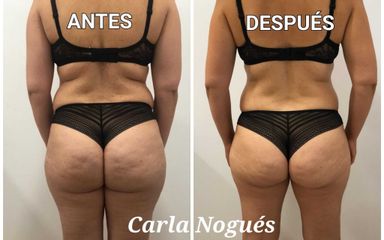 Presoterapia - Carla Nogués