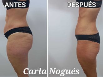 Cavitación antes y después - 842010