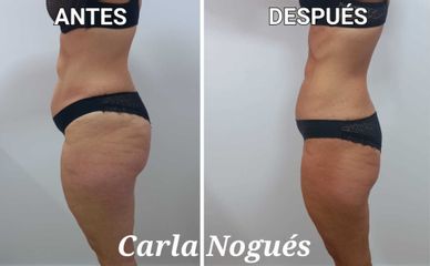 Cavitación - Carla Nogués