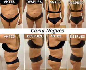 Liposucción - Carla Nogués
