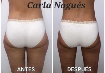 Lipoláser - Carla Nogués