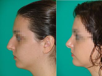 Rinoplastia - 634657