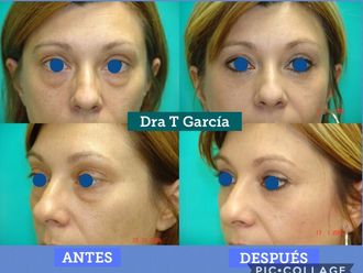 Blefaroplastia - 635279