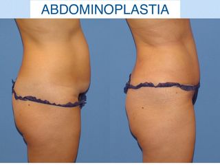Antes y después abdominoplastia