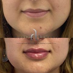 Aumento de labios - Clínica Rossi Lemarie