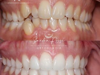 Blanqueamiento dental - 741628