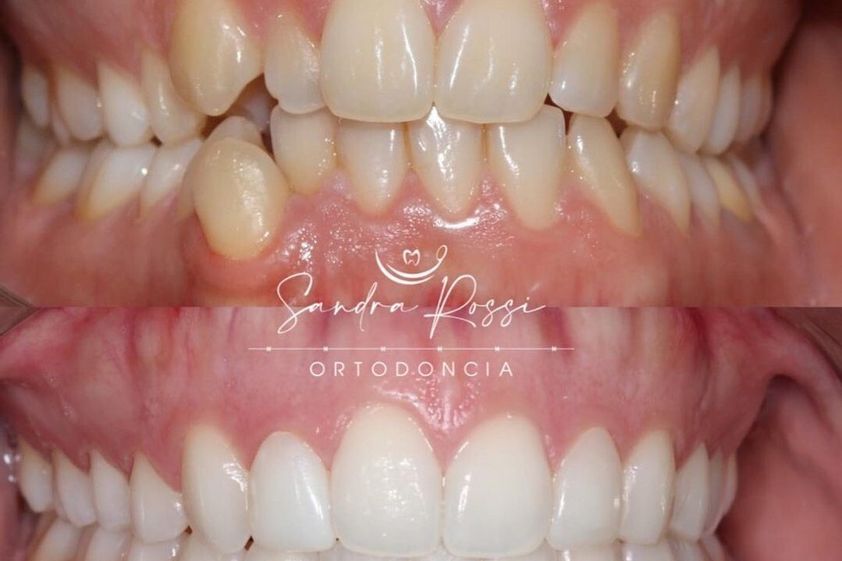Blanqueamiento dental antes y después - 741628