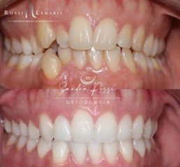 Blanqueamiento dental - Clínica Rossi Lemarie