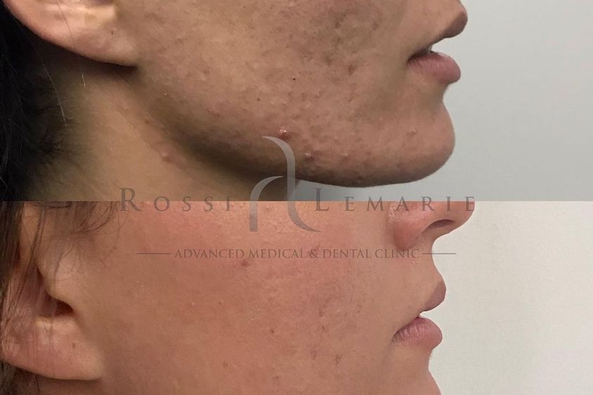 Tratamiento antiacné antes y después - 741632