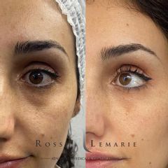 Eliminación de ojeras - Clínica Rossi Lemarie