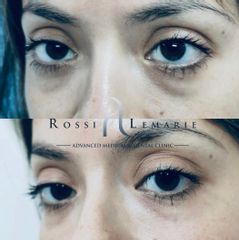 Eliminación de ojeras - Clínica Rossi Lemarie