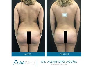 Liposucción - AA CLINIC