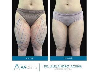 Liposucción - AA CLINIC