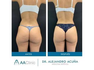 Liposucción - AA CLINIC