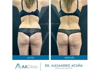 Liposucción - AA CLINIC